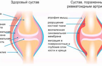 Ревматоидный артрит: народное лечение приносит облегчение! Если боль взяла в «плен» пора выбираться!