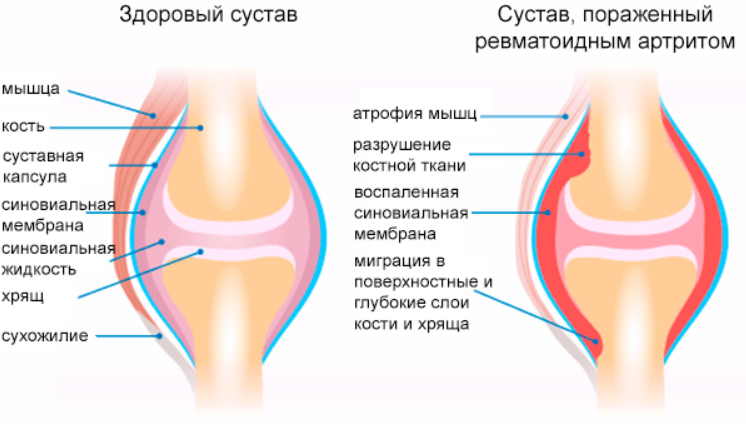 Ревматоидный артрит: народное лечение приносит облегчение! Если боль взяла в «плен» пора выбираться!