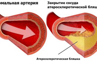 Склерозы: 5 ценных рецепта лечения!