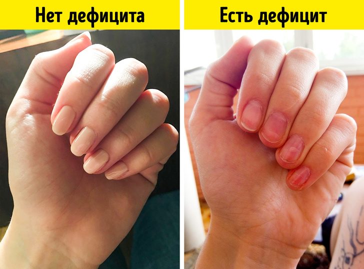 Признаки дефицита витамина С