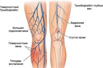 Тромбофлебит — исцеление без операции!