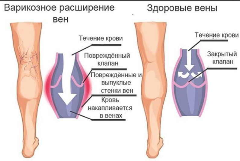 Тромбоз и варикоз можно вылечить народными способами. Мудрость предков на страже здоровья!