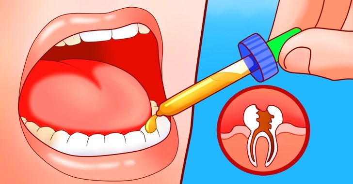 Домашние средства, снимающие зубную боль