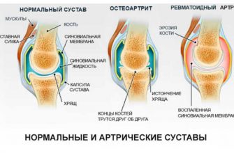 Раньше при малейшем переохлаждении нестерпимо болели колени, зато уже несколько лет забыла о боли!