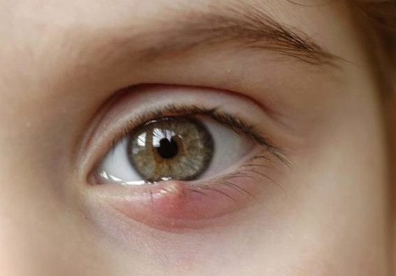 8 безопасных и эффективных способов избавиться от ячменя на глазу