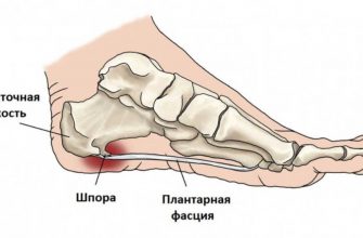 Ни шпор, ни бородавок — эти рецепты помогли сестре и знакомым