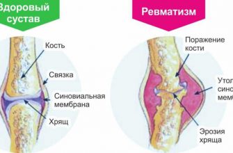 Ревматизм медом лечила — быстро болезнь победила. Рецепты простые, но золотые — боли нет!