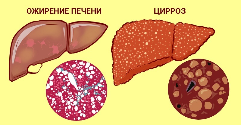 Очистить печень и восстановить все ее функции легко: всего пару глотков. Тяжесть после принятия пищи, боль в боку, слабость, одышка?