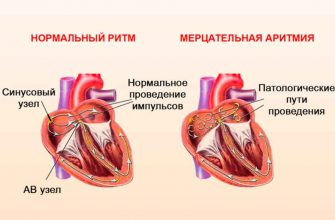 Аритмия — болезнь сердца, а лечить нужно нервы