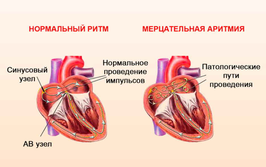 Аритмия — болезнь сердца, а лечить нужно нервы