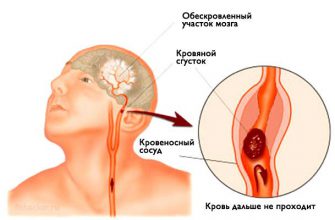 4 способа распознать инсульт, чтобы спасти себе и близким жизнь!