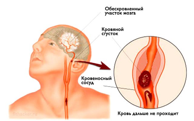 4 способа распознать инсульт, чтобы спасти себе и близким жизнь!