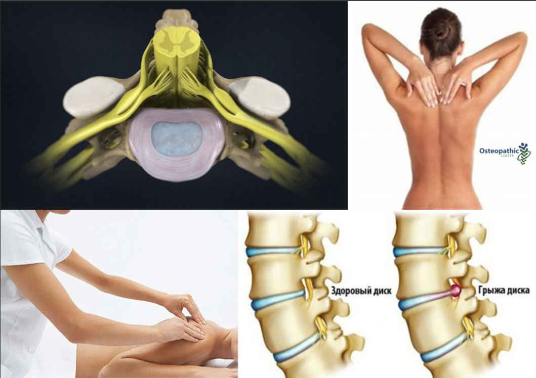 Протрузия лечение. Протрузии дисков позвоночника шейного отдела. Протрузия шейного отдела позвоночника. Протрузия поясничного отдела позвоночника. Протрузия межпозвонковых дисков шейного.