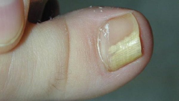 Эффективное 2-компонентное средство от грибка ногтей