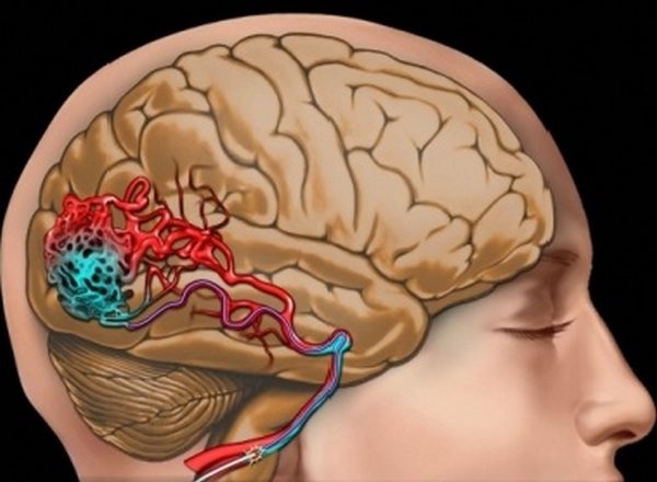 Причины, симптомы и лечение сужения сосудов головного мозга