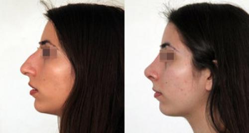Вздернутый нос у женщин. Форма носа и характер человека