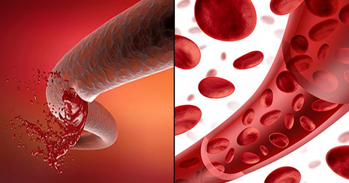 10 симптомов раннего предупреждения о сгустках в крови, которые вы никогда не должны игнорировать