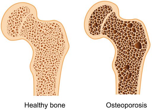 Как обеспечить здоровье костной ткани