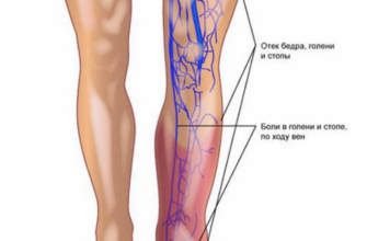 Как распознать варикоз