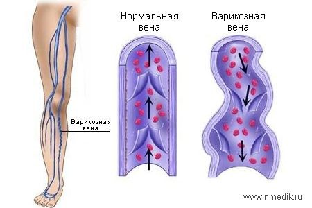 Как распознать варикоз