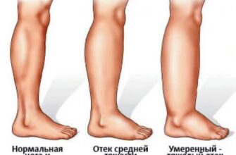 Полезные упражнения при застое лимфы в ногах